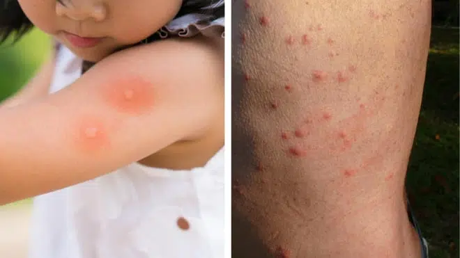 Piqûre moustique vs piqûre punaise de lit