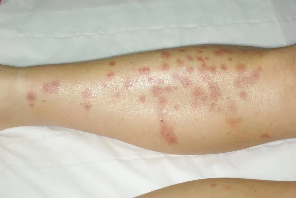 Piqûres punaises de lit